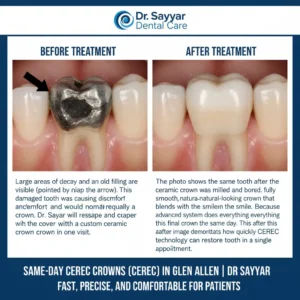 Same-Day Dental Crowns in Glen Allen: How CEREC Technology Saves You Time